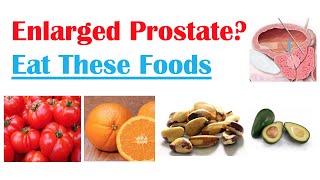 Best Foods to Eat with Enlarged Prostate | Reduce Risk of Symptoms, Enlargement & Cancer