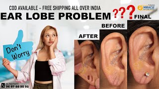 Ear Repair /Earlobe / Hole Repair By Ear Pasting lotion / Torn Ear lobe Repaired Earlobe -9687889595