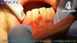 CẮT PHANH MÔI BẰNG MÁY LASER PICASSO