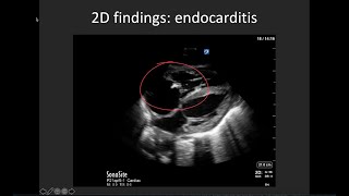 Basic Valve Evaluation with POCUS