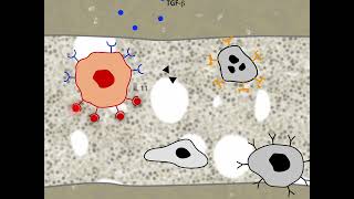 Vicious cycle in the generation of osteoclastic bone metastases in mammary cancer HD