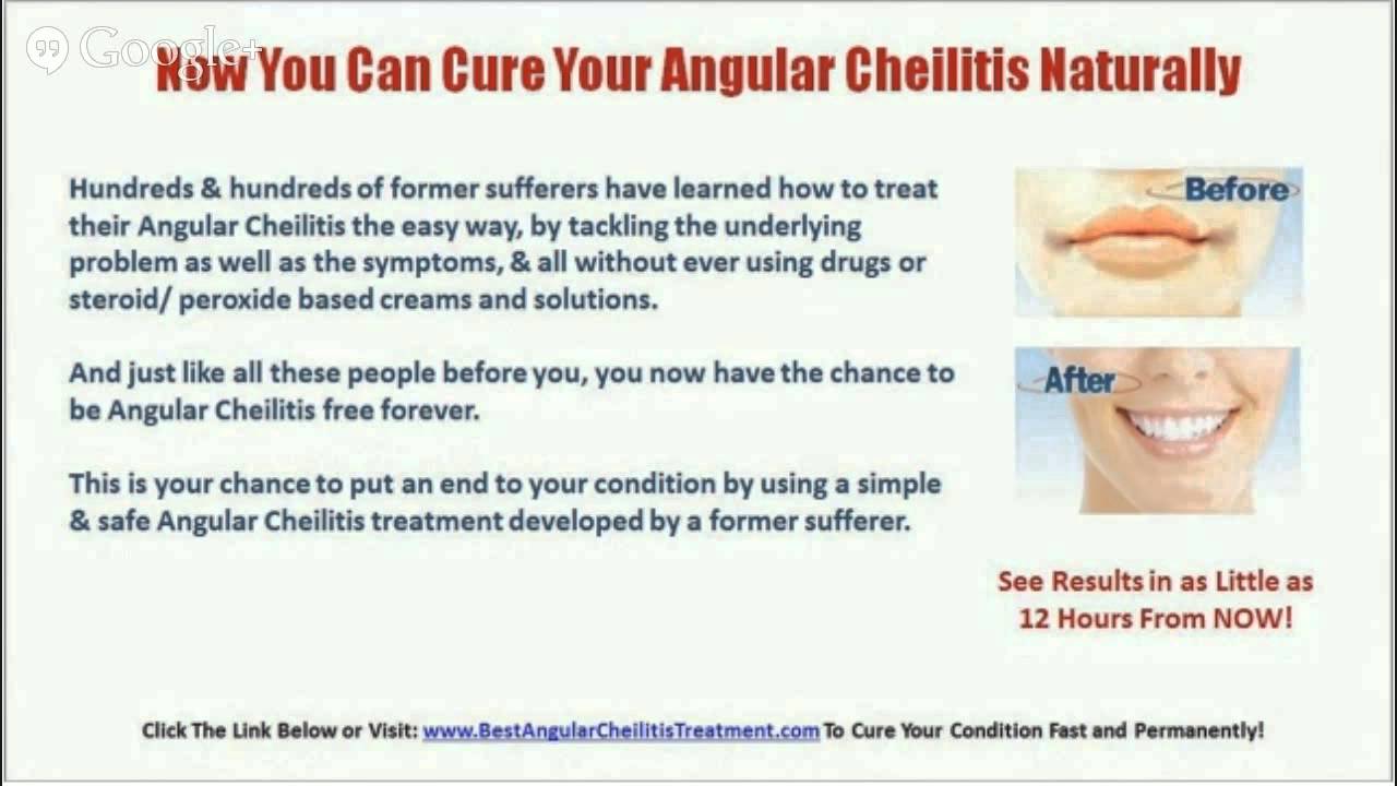 Pictures Of Angular Cheilitis - Angular Cheilitis Cure - YouTube