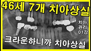 크라운 과잉진료하니까 임플란트하고 치료비 1200만원 나오는 거다. 치아관리01강 46세환자의 치과체험 극과극 2021_10_04