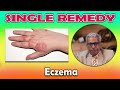 Single Remedy - Eczema -- Dr P.S. Tiwari