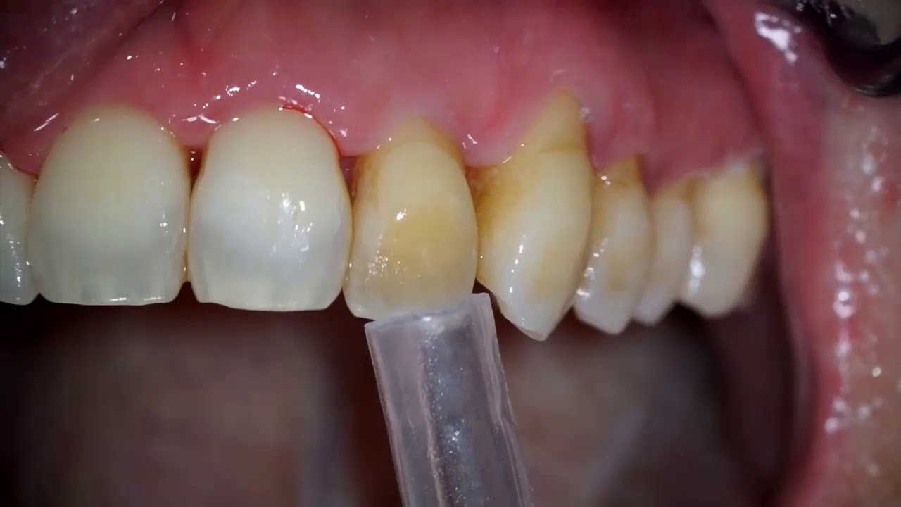 Sandblasting Teeth Air Fow Youtube