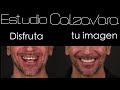 Carillas Dentales de Cerámica (Antes y después) - Estudio Calzavara