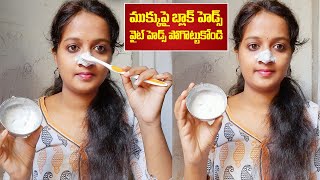 ముక్కు మీద బ్లాక్ హెడ్స్ పోగొట్టుకోండి | Remove Black Heads, White Heads on Nose in Telugu | Nose