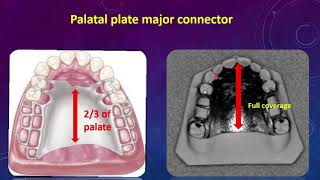 lec 7 Maxillary Major Connector 1