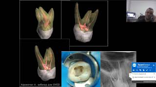 Вебинар №3 - Частная анатомия корневых каналов.