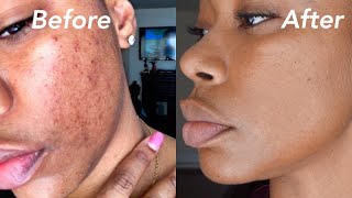 HOW I REMOVED MY HYPER PIGMENTATION IN 60 DAYS |ChimereNicole