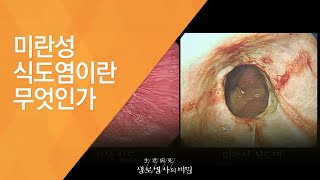 미란성 식도염이란 무엇인가 - (20150325_539회 방송)_속 타는 병, 역류성 식도염