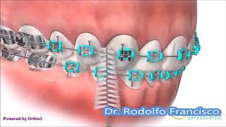 Orthodontic Appliance Care