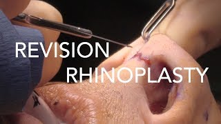 Revision Rhinoplasty | Nose Job | Correction Surgery | Dr. Daniel Barrett | Beverly Hills