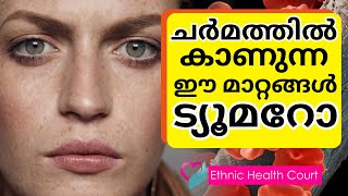 ചർമത്തിൽ കാണുന്ന ഈ മാറ്റങ്ങൾ അവഗണിക്കരുത്.| Ethnic Health Court