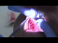 functional frenuloplasty with integrated myofunctional therapy surgical footage