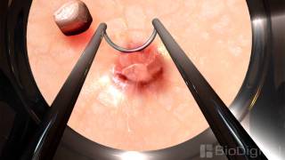 3D Medical Animation - Bladder Tumor Removal
