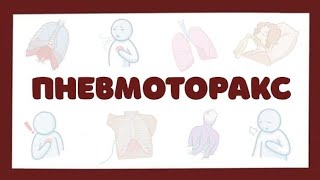 Пневмоторакс - причины, симптомы, лечение (хирургия) лекция