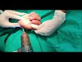 1st Metacarpal base fracture | Percutaneous K-wire fixation | Closed reduction | Adamya hospital vid