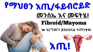 የማህፀን እጢ ፋይብሮይድ ወይም ማዮማ የሚከሰትበት መንስኤ ምልክቶች እና የህክምና ሁኔታ| Fibroid causes,sign and treatments| ጤና