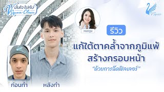 แก้ไขใต้ตาคล้ำ จากภูมิแพ้ ลดเหนียง สร้างกรอบหน้าด้วยฟิลเลอร์ l มั่นใจไปกับ V Square Clinic