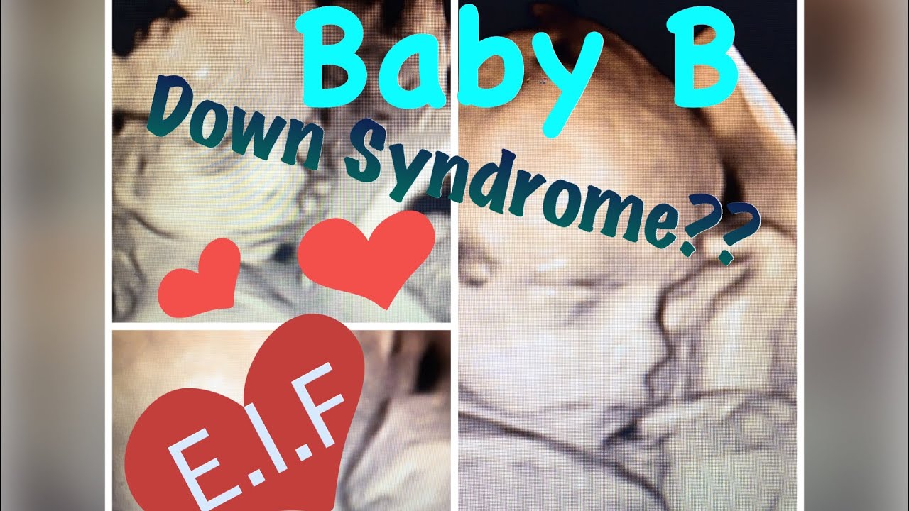 Does Baby B Have Down Syndrome? - YouTube