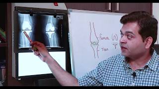 What is TOTAL KNEE REPLACEMENT SURGERY (TKR) X-RAY of KNEE REPLACEMENT- How to increase knee gap