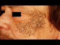 Sebaceous Cysts, Blackheads and Comedones!