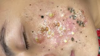 Big Cystic Acne Blackheads Extraction Blackheads \u0026 Milia, Whiteheads Removal Pimple Popping # 65696