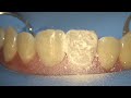 step by step class iv direct composite restoration upper central incisor