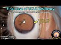 CataractCoach 1597: final cataract case of UCLA ophthalmology residency (Jules Stein Eye Institute)