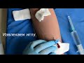 Катетеризация периферической вены peripheral venous cannulation