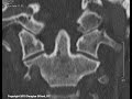 Upper Cervical Anatomy: (Part II): Embryology & Anomaly, Suboccipital Triangle, and Meet Axis