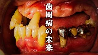 重度歯周病   残された最後の手立て