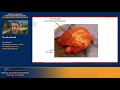 Timothy PAWLIK. Intrahepatic Cholangiocarcinoma: Multi-Disciplinary Care for a Challenging Disease