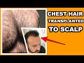 FUE SURGERY BODY HAIR TO SCALP | What Happened With His Chest Hair? #shorts #hairtransplantresults