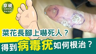 菜花長腳上嚇死人？得到病毒疣如何根治？【京硯皮膚科診所】