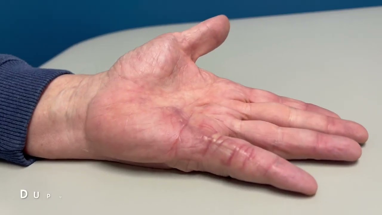 Dupuytren's Contracture Before And After Surgery - YouTube