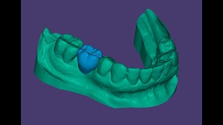 ExoCAD: Quick Wax Up for 3 Unit Bridge