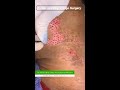 punch grafting vitiligo surgery treatment at skinaa clinic shorts punch_grafting vitiligo_surgery