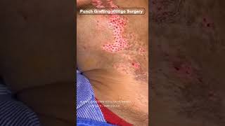 Punch grafting vitiligo surgery treatment at Skinaa clinic #shorts #punch_grafting #vitiligo_surgery