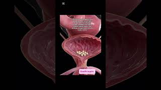 Doctor explains bladder stones in less than a minute! #bladderstones #2025 #viralvideo #viralshorts