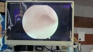 Hysteroscopy | Diagnostic hysteroscopy | Hysteroscopy done at NRS Medical college and hospital