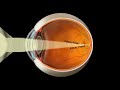 refractive error of eye