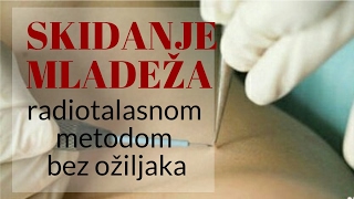 Radiotalasno skidanje (uklanjanje, operacija) mladeža bez ožiljka i bezbolno