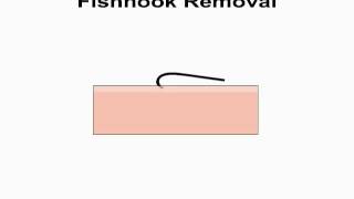 Animated Fish Hook Removal - advance and cut technique by NetKnots
