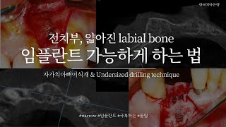 [한국치아은행] 68. 얇아진 전치부 labial bone! narrow 임플란트도 어려워보일 때, 어떤 방법이 있을까?(AutoBT dentin powder+root block)