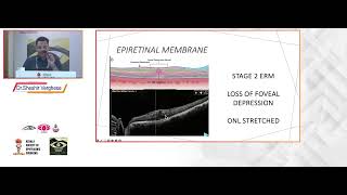 KSOS2024 IC8 T2 Dr Shishir VergheseOCT BIOMARKERS IN VITREOMACULAR INTERFACE DISORDERS