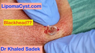 Is it a Blackhead? Let me know...Dr Khaled Sadek. LipomaCyst.com