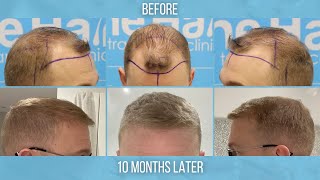 Scott's FUE Hair Transplant Journey by Dr Arshad (fair, blonde hair characteristics)