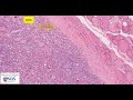 Thyroid follicular adenoma microscopy - Talking slide